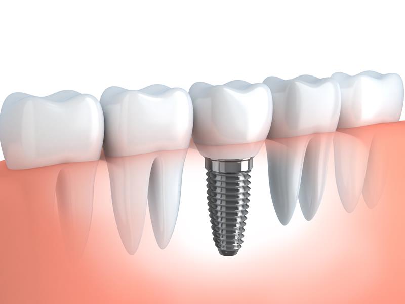 Dental Implants  Melbourne, FL 